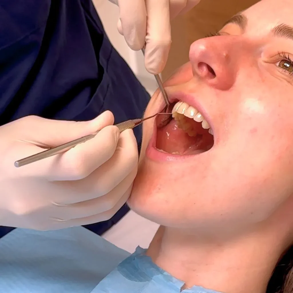 Faccette Dentali 1 Faccette dentali a Trento