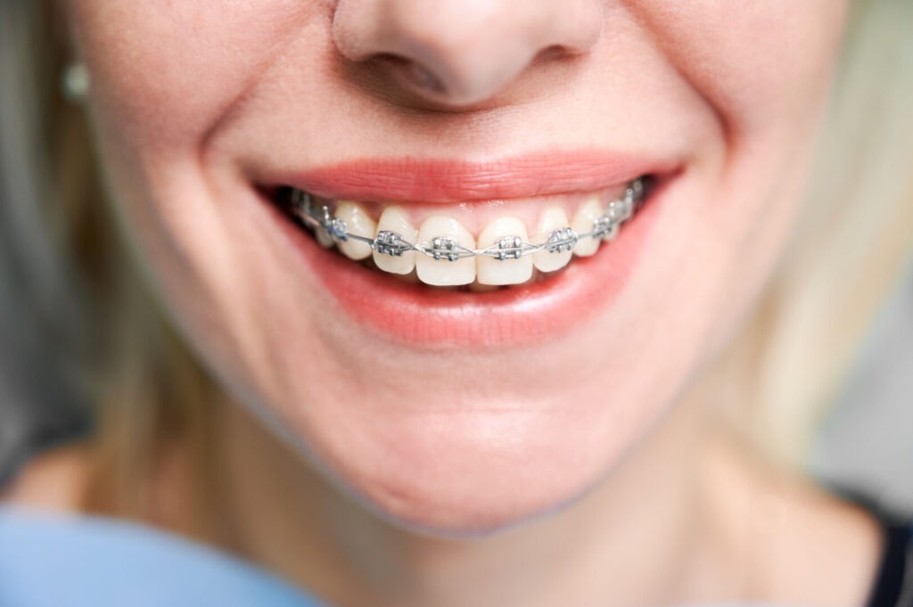 Mal di denti da apparecchio