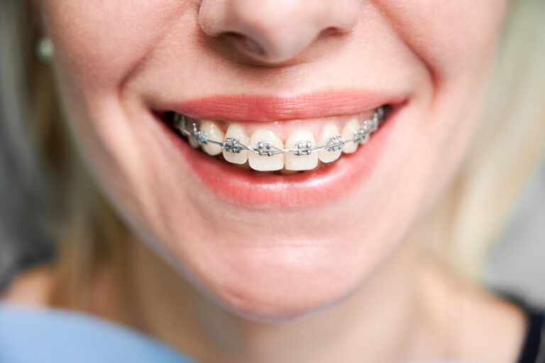 Blog 1 Mal di denti da apparecchio